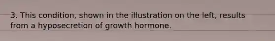 3. This condition, shown in the illustration on the left, results from a hyposecretion of growth hormone.