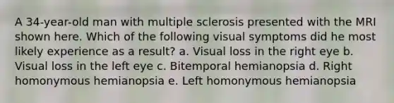 A 34-year-old man with multiple sclerosis presented with the MRI shown here. Which of the following visual symptoms did he most likely experience as a result? a. Visual loss in the right eye b. Visual loss in the left eye c. Bitemporal hemianopsia d. Right homonymous hemianopsia e. Left homonymous hemianopsia