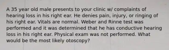 A 35 year old male presents to your clinic w/ complaints of hearing loss in his right ear. He denies pain, injury, or ringing of his right ear. Vitals are normal. Weber and Rinne test was performed and it was determined that he has conductive hearing loss in his right ear. Physical exam was not performed. What would be the most likely otoscopy?