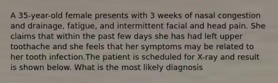 A 35-year-old female presents with 3 weeks of nasal congestion and drainage, fatigue, and intermittent facial and head pain. She claims that within the past few days she has had left upper toothache and she feels that her symptoms may be related to her tooth infection.The patient is scheduled for X-ray and result is shown below. What is the most likely diagnosis