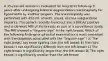 A 35-year-old woman is evaluated for long-term follow-up 9 years after undergoing bilateral augmentation mammaplasty for hypomastia by another surgeon. The mammaplasty was performed with 450-mL smooth, round, silicone subglandular implants. The patient recently found out she is BRCA2 positive and underwent MRI of the breasts as part of a surveillance study. The MRI showed a "linguine sign" in the right breast. Which of the following findings on physical examination is most consistent with the diagnosis associated with the "linguine sign"? A) The right breast has more rippling than the left breast B) The right breast is not significantly different from the left breast C) The right breast is significantly larger than the left breast D) The right breast is significantly smaller than the left breast