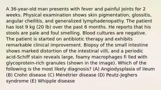 A 36-year-old man presents with fever and painful joints for 2 weeks. Physical examination shows skin pigmentation, glossitis, angular cheilitis, and generalized lymphadenopathy. The patient has lost 9 kg (20 lb) over the past 6 months. He reports that his stools are pale and foul smelling. Blood cultures are negative. The patient is started on antibiotic therapy and exhibits remarkable clinical improvement. Biopsy of the small intestine shows marked distortion of the intestinal villi, and a periodic acid-Schiff stain reveals large, foamy macrophages fi lled with glycoprotein-rich granules (shown in the image). Which of the following is the most likely diagnosis? (A) Angiodysplasia of ileum (B) Crohn disease (C) Ménétrier disease (D) Peutz-Jeghers syndrome (E) Whipple disease