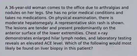 A 36-year-old woman comes to the office due to arthralgias and nodules on her legs. She has no prior medical conditions and takes no medications. On physical examination, there is moderate hepatomegaly. A representative skin rash is shown. The lesions are tender and present predominantly on the anterior surface of the lower extremities. Chest x-ray demonstrates enlarged hilar lymph nodes, and laboratory testing reveals an elevated ACE level. Which of the following would most likely be found on liver biopsy in this patient?