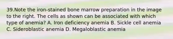 39.Note the iron-stained bone marrow preparation in the image to the right. The cells as shown can be associated with which type of anemia? A. Iron deficiency anemia B. Sickle cell anemia C. Sideroblastic anemia D. Megaloblastic anemia