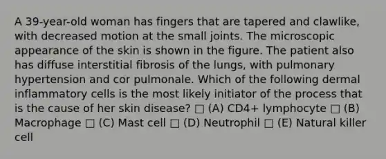 A 39-year-old woman has fingers that are tapered and clawlike, with decreased motion at the small joints. The microscopic appearance of the skin is shown in the figure. The patient also has diffuse interstitial fibrosis of the lungs, with pulmonary hypertension and cor pulmonale. Which of the following dermal inflammatory cells is the most likely initiator of the process that is the cause of her skin disease? □ (A) CD4+ lymphocyte □ (B) Macrophage □ (C) Mast cell □ (D) Neutrophil □ (E) Natural killer cell