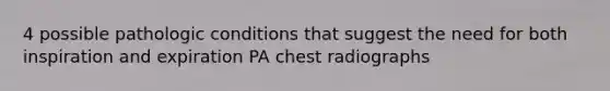 4 possible pathologic conditions that suggest the need for both inspiration and expiration PA chest radiographs