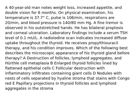 A 40-year-old man notes weight loss, increased appetite, and double vision for 6 months. On physical examination, his temperature is 37.7° C, pulse is 106/min, respirations are 20/min, and blood pressure is 140/80 mm Hg. A fine tremor is observed in his outstretched hands. He has bilateral proptosis and corneal ulceration. Laboratory findings include a serum TSH level of 0.1 mU/L. A radioiodine scan indicates increased diffuse uptake throughout the thyroid. He receives propylthiouracil therapy, and his condition improves. Which of the following best describes the microscopic appearance of his thyroid gland before therapy? A Destruction of follicles, lymphoid aggregates, and Hürthle cell metaplasia B Enlarged thyroid follicles lined by flattened epithelial cells C Follicular destruction with inflammatory infiltrates containing giant cells D Nodules with nests of cells separated by hyaline stroma that stains with Congo red E Papillary projections in thyroid follicles and lymphoid aggregates in the stroma