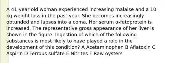 A 41-year-old woman experienced increasing malaise and a 10-kg weight loss in the past year. She becomes increasingly obtunded and lapses into a coma. Her serum α-fetoprotein is increased. The representative gross appearance of her liver is shown in the figure. Ingestion of which of the following substances is most likely to have played a role in the development of this condition? A Acetaminophen B Aflatoxin C Aspirin D Ferrous sulfate E Nitrites F Raw oysters