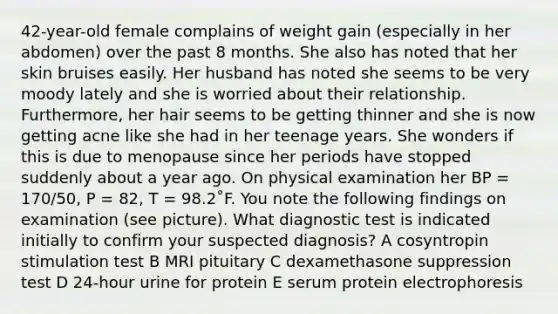 42-year-old female complains of weight gain (especially in her abdomen) over the past 8 months. She also has noted that her skin bruises easily. Her husband has noted she seems to be very moody lately and she is worried about their relationship. Furthermore, her hair seems to be getting thinner and she is now getting acne like she had in her teenage years. She wonders if this is due to menopause since her periods have stopped suddenly about a year ago. On physical examination her BP = 170/50, P = 82, T = 98.2˚F. You note the following findings on examination (see picture). What diagnostic test is indicated initially to confirm your suspected diagnosis? A cosyntropin stimulation test B MRI pituitary C dexamethasone suppression test D 24-hour urine for protein E serum protein electrophoresis