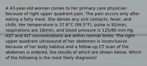 A 43-year-old woman comes to her primary care physician because of right upper quadrant pain. The pain occurs only after eating a fatty meal. She denies any sick contacts, fever, and chills. Her temperature is 37.6°C (99.5°F), pulse is 92/min, respirations are 18/min, and blood pressure is 125/80 mm Hg. AST and ALT concentrations are within normal limits. The right upper quadrant ultrasound of her abdomen is inconclusive because of her body habitus and a follow-up CT scan of the abdomen is ordered, the results of which are shown below. Which of the following is the most likely diagnosis?