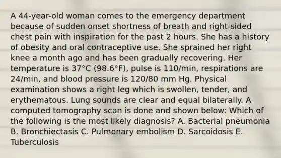 A 44-year-old woman comes to the emergency department because of sudden onset shortness of breath and right-sided chest pain with inspiration for the past 2 hours. She has a history of obesity and oral contraceptive use. She sprained her right knee a month ago and has been gradually recovering. Her temperature is 37°C (98.6°F), pulse is 110/min, respirations are 24/min, and blood pressure is 120/80 mm Hg. Physical examination shows a right leg which is swollen, tender, and erythematous. Lung sounds are clear and equal bilaterally. A computed tomography scan is done and shown below: Which of the following is the most likely diagnosis? A. Bacterial pneumonia B. Bronchiectasis C. Pulmonary embolism D. Sarcoidosis E. Tuberculosis