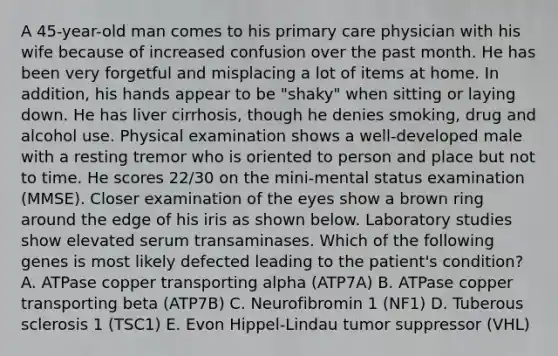 A 45-year-old man comes to his primary care physician with his wife because of increased confusion over the past month. He has been very forgetful and misplacing a lot of items at home. In addition, his hands appear to be "shaky" when sitting or laying down. He has liver cirrhosis, though he denies smoking, drug and alcohol use. Physical examination shows a well-developed male with a resting tremor who is oriented to person and place but not to time. He scores 22/30 on the mini-mental status examination (MMSE). Closer examination of the eyes show a brown ring around the edge of his iris as shown below. Laboratory studies show elevated serum transaminases. Which of the following genes is most likely defected leading to the patient's condition? A. ATPase copper transporting alpha (ATP7A) B. ATPase copper transporting beta (ATP7B) C. Neurofibromin 1 (NF1) D. Tuberous sclerosis 1 (TSC1) E. Evon Hippel-Lindau tumor suppressor (VHL)