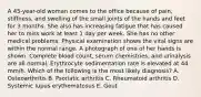 A 45-year-old woman comes to the office because of pain, stiffness, and swelling of the small joints of the hands and feet for 3 months. She also has increasing fatigue that has caused her to miss work at least 1 day per week. She has no other medical problems. Physical examination shows the vital signs are within the normal range. A photograph of one of her hands is shown. Complete blood count, serum chemistries, and urinalysis are all normal. Erythrocyte sedimentation rate is elevated at 44 mm/h. Which of the following is the most likely diagnosis? A. Osteoarthritis B. Psoriatic arthritis C. Rheumatoid arthritis D. Systemic lupus erythematosus E. Gout