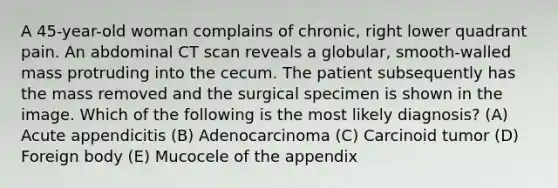 A 45-year-old woman complains of chronic, right lower quadrant pain. An abdominal CT scan reveals a globular, smooth-walled mass protruding into the cecum. The patient subsequently has the mass removed and the surgical specimen is shown in the image. Which of the following is the most likely diagnosis? (A) Acute appendicitis (B) Adenocarcinoma (C) Carcinoid tumor (D) Foreign body (E) Mucocele of the appendix