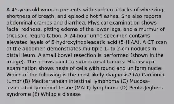 A 45-year-old woman presents with sudden attacks of wheezing, shortness of breath, and episodic hot fl ashes. She also reports abdominal cramps and diarrhea. Physical examination shows facial redness, pitting edema of the lower legs, and a murmur of tricuspid regurgitation. A 24-hour urine specimen contains elevated levels of 5-hydroxyindoleacetic acid (5-HIAA). A CT scan of the abdomen demonstrates multiple 1- to 2-cm nodules in distal ileum. A small bowel resection is performed (shown in the image). The arrows point to submucosal tumors. Microscopic examination shows nests of cells with round and uniform nuclei. Which of the following is the most likely diagnosis? (A) Carcinoid tumor (B) Mediterranean intestinal lymphoma (C) Mucosa-associated lymphoid tissue (MALT) lymphoma (D) Peutz-Jeghers syndrome (E) Whipple disease