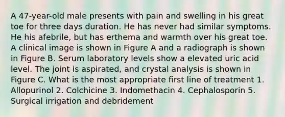 A 47-year-old male presents with pain and swelling in his great toe for three days duration. He has never had similar symptoms. He his afebrile, but has erthema and warmth over his great toe. A clinical image is shown in Figure A and a radiograph is shown in Figure B. Serum laboratory levels show a elevated uric acid level. The joint is aspirated, and crystal analysis is shown in Figure C. What is the most appropriate first line of treatment 1. Allopurinol 2. Colchicine 3. Indomethacin 4. Cephalosporin 5. Surgical irrigation and debridement