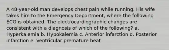 A 48-year-old man develops chest pain while running. His wife takes him to the Emergency Department, where the following ECG is obtained. The electrocardiographic changes are consistent with a diagnosis of which of the following? a. Hyperkalemia b. Hypokalemia c. Anterior infarction d. Posterior infarction e. Ventricular premature beat