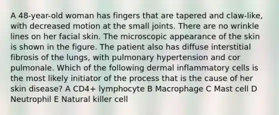 A 48-year-old woman has fingers that are tapered and claw-like, with decreased motion at the small joints. There are no wrinkle lines on her facial skin. The microscopic appearance of the skin is shown in the figure. The patient also has diffuse interstitial fibrosis of the lungs, with pulmonary hypertension and cor pulmonale. Which of the following dermal inflammatory cells is the most likely initiator of the process that is the cause of her skin disease? A CD4+ lymphocyte B Macrophage C Mast cell D Neutrophil E Natural killer cell