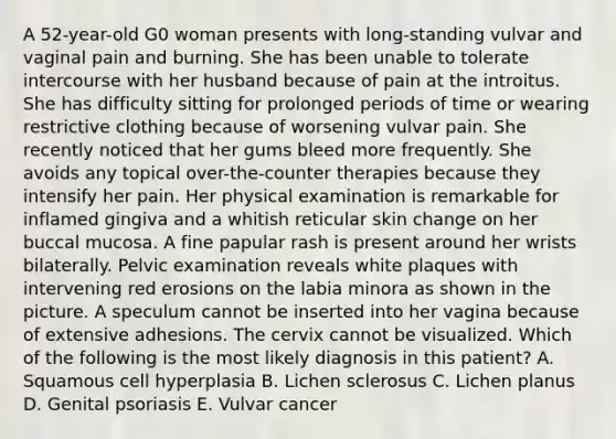 A 52-year-old G0 woman presents with long-standing vulvar and vaginal pain and burning. She has been unable to tolerate intercourse with her husband because of pain at the introitus. She has difficulty sitting for prolonged periods of time or wearing restrictive clothing because of worsening vulvar pain. She recently noticed that her gums bleed more frequently. She avoids any topical over-the-counter therapies because they intensify her pain. Her physical examination is remarkable for inflamed gingiva and a whitish reticular skin change on her buccal mucosa. A fine papular rash is present around her wrists bilaterally. Pelvic examination reveals white plaques with intervening red erosions on the labia minora as shown in the picture. A speculum cannot be inserted into her vagina because of extensive adhesions. The cervix cannot be visualized. Which of the following is the most likely diagnosis in this patient? A. Squamous cell hyperplasia B. Lichen sclerosus C. Lichen planus D. Genital psoriasis E. Vulvar cancer