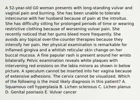 A 52-year-old G0 woman presents with long-standing vulvar and vaginal pain and burning. She has been unable to tolerate intercourse with her husband because of pain at the introitus. She has difficulty sitting for prolonged periods of time or wearing restrictive clothing because of worsening vulvar pain. She recently noticed that her gums bleed more frequently. She avoids any topical over-the-counter therapies because they intensify her pain. Her physical examination is remarkable for inflamed gingiva and a whitish reticular skin change on her buccal mucosa. A fine papular rash is present around her wrists bilaterally. Pelvic examination reveals white plaques with intervening red erosions on the labia minora as shown in below picture. A speculum cannot be inserted into her vagina because of extensive adhesions. The cervix cannot be visualized. Which of the following is the most likely diagnosis in this patient? A. Squamous cell hyperplasia B. Lichen sclerosus C. Lichen planus D. Genital psoriasis E. Vulvar cancer