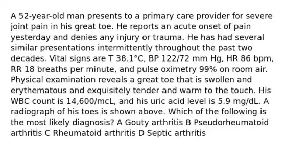 A 52-year-old man presents to a primary care provider for severe joint pain in his great toe. He reports an acute onset of pain yesterday and denies any injury or trauma. He has had several similar presentations intermittently throughout the past two decades. Vital signs are T 38.1°C, BP 122/72 mm Hg, HR 86 bpm, RR 18 breaths per minute, and pulse oximetry 99% on room air. Physical examination reveals a great toe that is swollen and erythematous and exquisitely tender and warm to the touch. His WBC count is 14,600/mcL, and his uric acid level is 5.9 mg/dL. A radiograph of his toes is shown above. Which of the following is the most likely diagnosis? A Gouty arthritis B Pseudorheumatoid arthritis C Rheumatoid arthritis D Septic arthritis