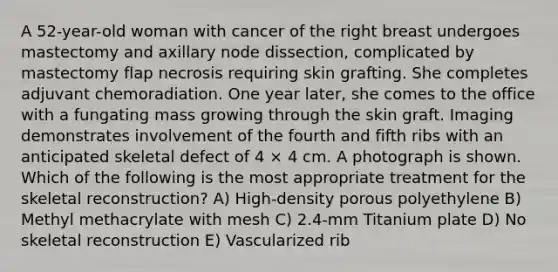 A 52-year-old woman with cancer of the right breast undergoes mastectomy and axillary node dissection, complicated by mastectomy flap necrosis requiring skin grafting. She completes adjuvant chemoradiation. One year later, she comes to the office with a fungating mass growing through the skin graft. Imaging demonstrates involvement of the fourth and fifth ribs with an anticipated skeletal defect of 4 × 4 cm. A photograph is shown. Which of the following is the most appropriate treatment for the skeletal reconstruction? A) High-density porous polyethylene B) Methyl methacrylate with mesh C) 2.4-mm Titanium plate D) No skeletal reconstruction E) Vascularized rib