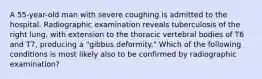 A 55-year-old man with severe coughing is admitted to the hospital. Radiographic examination reveals tuberculosis of the right lung, with extension to the thoracic vertebral bodies of T6 and T7, producing a "gibbus deformity." Which of the following conditions is most likely also to be confirmed by radiographic examination?