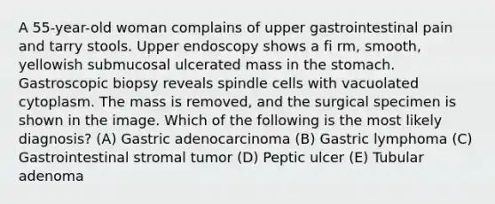 A 55-year-old woman complains of upper gastrointestinal pain and tarry stools. Upper endoscopy shows a fi rm, smooth, yellowish submucosal ulcerated mass in the stomach. Gastroscopic biopsy reveals spindle cells with vacuolated cytoplasm. The mass is removed, and the surgical specimen is shown in the image. Which of the following is the most likely diagnosis? (A) Gastric adenocarcinoma (B) Gastric lymphoma (C) Gastrointestinal stromal tumor (D) Peptic ulcer (E) Tubular adenoma