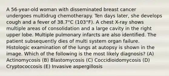 A 56-year-old woman with disseminated breast cancer undergoes multidrug chemotherapy. Ten days later, she develops cough and a fever of 38.7°C (103°F). A chest X-ray shows multiple areas of consolidation and a large cavity in the right upper lobe. Multiple pulmonary infarcts are also identified. The patient subsequently dies of multi system organ failure. Histologic examination of the lungs at autopsy is shown in the image. Which of the following is the most likely diagnosis? (A) Actinomycosis (B) Blastomycosis (C) Coccidioidomycosis (D) Cryptococcosis (E) Invasive aspergillosis