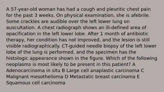 A 57-year-old woman has had a cough and pleuritic chest pain for the past 3 weeks. On physical examination, she is afebrile. Some crackles are audible over the left lower lung on auscultation. A chest radiograph shows an ill-defined area of opacification in the left lower lobe. After 1 month of antibiotic therapy, her condition has not improved, and the lesion is still visible radiographically. CT-guided needle biopsy of the left lower lobe of the lung is performed, and the specimen has the histologic appearance shown in the figure. Which of the following neoplasms is most likely to be present in this patient? A Adenocarcinoma in situ B Large cell anaplastic carcinoma C Malignant mesothelioma D Metastatic breast carcinoma E Squamous cell carcinoma