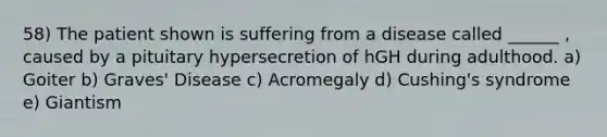 58) The patient shown is suffering from a disease called ______ , caused by a pituitary hypersecretion of hGH during adulthood. a) Goiter b) Graves' Disease c) Acromegaly d) Cushing's syndrome e) Giantism