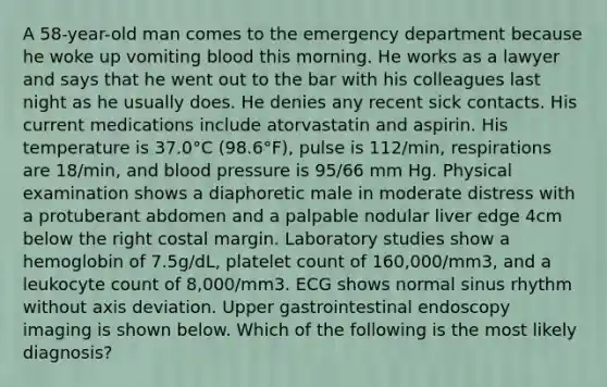 A 58-year-old man comes to the emergency department because he woke up vomiting blood this morning. He works as a lawyer and says that he went out to the bar with his colleagues last night as he usually does. He denies any recent sick contacts. His current medications include atorvastatin and aspirin. His temperature is 37.0°C (98.6°F), pulse is 112/min, respirations are 18/min, and blood pressure is 95/66 mm Hg. Physical examination shows a diaphoretic male in moderate distress with a protuberant abdomen and a palpable nodular liver edge 4cm below the right costal margin. Laboratory studies show a hemoglobin of 7.5g/dL, platelet count of 160,000/mm3, and a leukocyte count of 8,000/mm3. ECG shows normal sinus rhythm without axis deviation. Upper gastrointestinal endoscopy imaging is shown below. Which of the following is the most likely diagnosis?