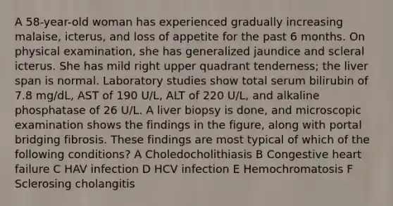 A 58-year-old woman has experienced gradually increasing malaise, icterus, and loss of appetite for the past 6 months. On physical examination, she has generalized jaundice and scleral icterus. She has mild right upper quadrant tenderness; the liver span is normal. Laboratory studies show total serum bilirubin of 7.8 mg/dL, AST of 190 U/L, ALT of 220 U/L, and alkaline phosphatase of 26 U/L. A liver biopsy is done, and microscopic examination shows the findings in the figure, along with portal bridging fibrosis. These findings are most typical of which of the following conditions? A Choledocholithiasis B Congestive heart failure C HAV infection D HCV infection E Hemochromatosis F Sclerosing cholangitis