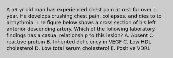 A 59 yr old man has experienced chest pain at rest for over 1 year. He develops crushing chest pain, collapses, and dies to to arrhythmia. The figure below shows a cross section of his left anterior descending artery. Which of the following laboratory findings has a casual relationship to this lesion? A. Absent C-reactive protein B. Inherited deficiency in VEGF C. Low HDL cholesterol D. Low total serum cholesterol E. Positive VDRL