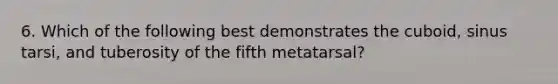 6. Which of the following best demonstrates the cuboid, sinus tarsi, and tuberosity of the fifth metatarsal?