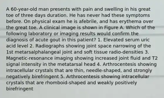 A 60-year-old man presents with pain and swelling in his great toe of three days duration. He has never had these symptoms before. On physical exam he is afebrile, and has erythema over the great toe. A clinical image is shown in Figure A. Which of the following laboratory or imaging results would confirm the diagnosis of acute gout in this patient? 1. Elevated serum uric acid level 2. Radiographs showing joint space narrowing of the 1st metarsalphalangeal joint and soft tissue radio-densities 3. Magnetic-resonance imaging showing increased joint fluid and T2 signal intensity in the metatarsal head 4. Arthrocentesis showing intracellular crystals that are thin, needle-shaped, and strongly negatively birefringent 5. Arthrocentesis showing intracellular crystals that are rhomboid-shaped and weakly positively birefringent