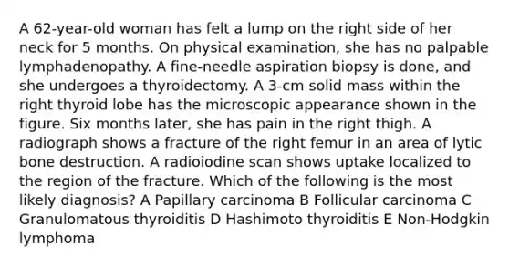 A 62-year-old woman has felt a lump on the right side of her neck for 5 months. On physical examination, she has no palpable lymphadenopathy. A fine-needle aspiration biopsy is done, and she undergoes a thyroidectomy. A 3-cm solid mass within the right thyroid lobe has the microscopic appearance shown in the figure. Six months later, she has pain in the right thigh. A radiograph shows a fracture of the right femur in an area of lytic bone destruction. A radioiodine scan shows uptake localized to the region of the fracture. Which of the following is the most likely diagnosis? A Papillary carcinoma B Follicular carcinoma C Granulomatous thyroiditis D Hashimoto thyroiditis E Non-Hodgkin lymphoma