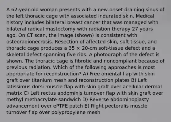 A 62-year-old woman presents with a new-onset draining sinus of the left thoracic cage with associated indurated skin. Medical history includes bilateral breast cancer that was managed with bilateral radical mastectomy with radiation therapy 27 years ago. On CT scan, the image (shown) is consistent with osteoradionecrosis. Resection of affected skin, soft tissue, and thoracic cage produces a 35 × 20-cm soft-tissue defect and a skeletal defect spanning five ribs. A photograph of the defect is shown. The thoracic cage is fibrotic and noncompliant because of previous radiation. Which of the following approaches is most appropriate for reconstruction? A) Free omental flap with skin graft over titanium mesh and reconstruction plates B) Left latissimus dorsi muscle flap with skin graft over acellular dermal matrix C) Left rectus abdominis turnover flap with skin graft over methyl methacrylate sandwich D) Reverse abdominoplasty advancement over ePTFE patch E) Right pectoralis muscle turnover flap over polypropylene mesh