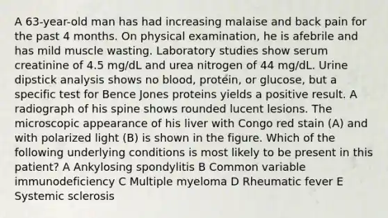 A 63-year-old man has had increasing malaise and back pain for the past 4 months. On physical examination, he is afebrile and has mild muscle wasting. Laboratory studies show serum creatinine of 4.5 mg/dL and urea nitrogen of 44 mg/dL. Urine dipstick analysis shows no blood, protein, or glucose, but a specific test for Bence Jones proteins yields a positive result. A radiograph of his spine shows rounded lucent lesions. The microscopic appearance of his liver with Congo red stain (A) and with polarized light (B) is shown in the figure. Which of the following underlying conditions is most likely to be present in this patient? A Ankylosing spondylitis B Common variable immunodeficiency C Multiple myeloma D Rheumatic fever E Systemic sclerosis