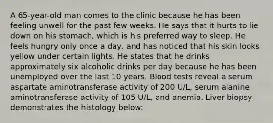 A 65-year-old man comes to the clinic because he has been feeling unwell for the past few weeks. He says that it hurts to lie down on his stomach, which is his preferred way to sleep. He feels hungry only once a day, and has noticed that his skin looks yellow under certain lights. He states that he drinks approximately six alcoholic drinks per day because he has been unemployed over the last 10 years. Blood tests reveal a serum aspartate aminotransferase activity of 200 U/L, serum alanine aminotransferase activity of 105 U/L, and anemia. Liver biopsy demonstrates the histology below: