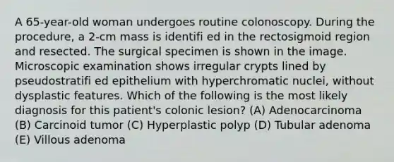 A 65-year-old woman undergoes routine colonoscopy. During the procedure, a 2-cm mass is identifi ed in the rectosigmoid region and resected. The surgical specimen is shown in the image. Microscopic examination shows irregular crypts lined by pseudostratifi ed epithelium with hyperchromatic nuclei, without dysplastic features. Which of the following is the most likely diagnosis for this patient's colonic lesion? (A) Adenocarcinoma (B) Carcinoid tumor (C) Hyperplastic polyp (D) Tubular adenoma (E) Villous adenoma