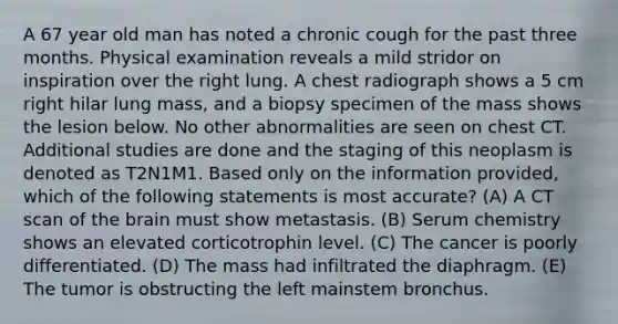 A 67 year old man has noted a chronic cough for the past three months. Physical examination reveals a mild stridor on inspiration over the right lung. A chest radiograph shows a 5 cm right hilar lung mass, and a biopsy specimen of the mass shows the lesion below. No other abnormalities are seen on chest CT. Additional studies are done and the staging of this neoplasm is denoted as T2N1M1. Based only on the information provided, which of the following statements is most accurate? (A) A CT scan of the brain must show metastasis. (B) Serum chemistry shows an elevated corticotrophin level. (C) The cancer is poorly differentiated. (D) The mass had infiltrated the diaphragm. (E) The tumor is obstructing the left mainstem bronchus.