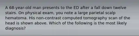 A 68-year-old man presents to the ED after a fall down twelve stairs. On physical exam, you note a large parietal scalp hematoma. His non-contrast computed tomography scan of the head is shown above. Which of the following is the most likely diagnosis?