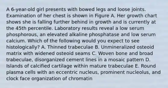 A 6-year-old girl presents with bowed legs and loose joints. Examination of her chest is shown in Figure A. Her growth chart shows she is falling further behind in growth and is currently at the 45th percentile. Laboratory results reveal a low serum phosphorous, an elevated alkaline phosphatase and low serum calcium. Which of the following would you expect to see histologically? A. Thinned trabeculae B. Unmineralized osteoid matrix with widened osteoid seams C. Woven bone and broad trabeculae, disorganized cement lines in a mosaic pattern D. Islands of calcified cartilage within mature trabeculae E. Round plasma cells with an eccentric nucleus, prominent nucleolus, and clock face organization of chromatin