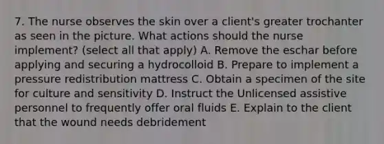 7. The nurse observes the skin over a client's greater trochanter as seen in the picture. What actions should the nurse implement? (select all that apply) A. Remove the eschar before applying and securing a hydrocolloid B. Prepare to implement a pressure redistribution mattress C. Obtain a specimen of the site for culture and sensitivity D. Instruct the Unlicensed assistive personnel to frequently offer oral fluids E. Explain to the client that the wound needs debridement