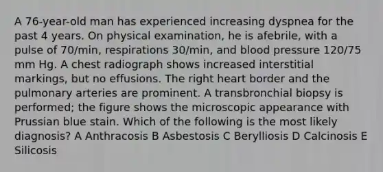 A 76-year-old man has experienced increasing dyspnea for the past 4 years. On physical examination, he is afebrile, with a pulse of 70/min, respirations 30/min, and blood pressure 120/75 mm Hg. A chest radiograph shows increased interstitial markings, but no effusions. The right heart border and the pulmonary arteries are prominent. A transbronchial biopsy is performed; the figure shows the microscopic appearance with Prussian blue stain. Which of the following is the most likely diagnosis? A Anthracosis B Asbestosis C Berylliosis D Calcinosis E Silicosis