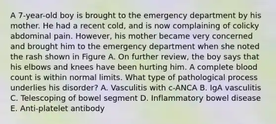 A 7-year-old boy is brought to the emergency department by his mother. He had a recent cold, and is now complaining of colicky abdominal pain. However, his mother became very concerned and brought him to the emergency department when she noted the rash shown in Figure A. On further review, the boy says that his elbows and knees have been hurting him. A complete blood count is within normal limits. What type of pathological process underlies his disorder? A. Vasculitis with c-ANCA B. IgA vasculitis C. Telescoping of bowel segment D. Inflammatory bowel disease E. Anti-platelet antibody