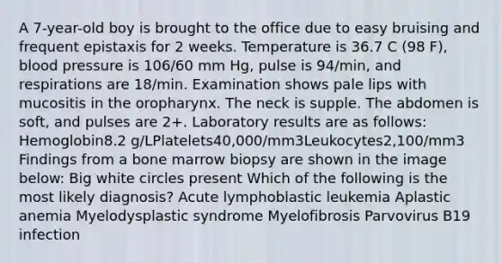 A 7-year-old boy is brought to the office due to easy bruising and frequent epistaxis for 2 weeks. Temperature is 36.7 C (98 F), <a href='https://www.questionai.com/knowledge/kD0HacyPBr-blood-pressure' class='anchor-knowledge'>blood pressure</a> is 106/60 mm Hg, pulse is 94/min, and respirations are 18/min. Examination shows pale lips with mucositis in the oropharynx. The neck is supple. The abdomen is soft, and pulses are 2+. Laboratory results are as follows: Hemoglobin8.2 g/LPlatelets40,000/mm3Leukocytes2,100/mm3 Findings from a bone marrow biopsy are shown in the image below: Big white circles present Which of the following is the most likely diagnosis? Acute lymphoblastic leukemia Aplastic anemia Myelodysplastic syndrome Myelofibrosis Parvovirus B19 infection