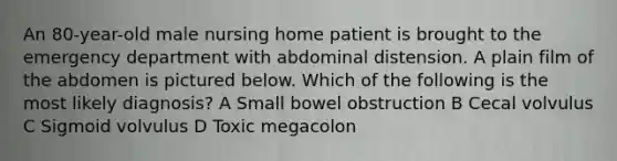 An 80-year-old male nursing home patient is brought to the emergency department with abdominal distension. A plain film of the abdomen is pictured below. Which of the following is the most likely diagnosis? A Small bowel obstruction B Cecal volvulus C Sigmoid volvulus D Toxic megacolon