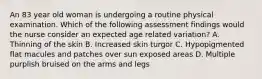 An 83 year old woman is undergoing a routine physical examination. Which of the following assessment findings would the nurse consider an expected age related variation? A. Thinning of the skin B. Increased skin turgor C. Hypopigmented flat macules and patches over sun exposed areas D. Multiple purplish bruised on the arms and legs